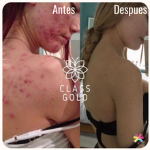 Cargar imagen en el visor de la galería, Kit Antiacné Class Gold Mas Obsequio