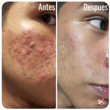 Cargar imagen en el visor de la galería, Kit Corporal Antiacné Class Gold Mas Obsequio